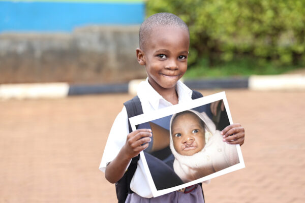 Cleft is a congenital birth defect which affects the child’s ability to breath, eat, speak and ultimately thrive. Because of the unfounded myths and misconceptions, children are isolated, stigmatized and abandoned or in some communities, even killed.