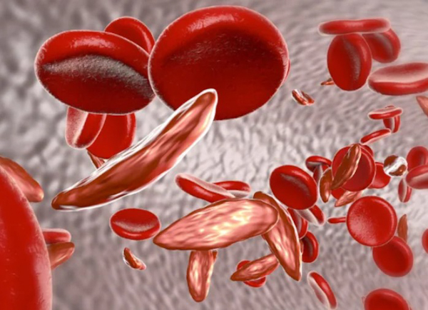Sickle Cell is a genetic disease characterized by a change in the shape of a red blood cell, from a smooth circular shape to a crescent shape, which can result in the blockage of small blood vessels.
