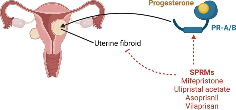 Common Uterine Fibroids: Risks, Symptoms, Treatments Explained Fibroids are non-cancerous growths that develop in or around the womb.